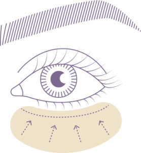 blefaroplastia en monterrey