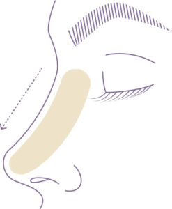 rinoplastia en monterrey