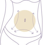 Abdominoplastia en Monterrey